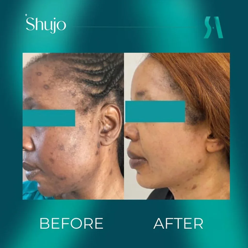 hyperpigmentation client result- shujo aesthetics