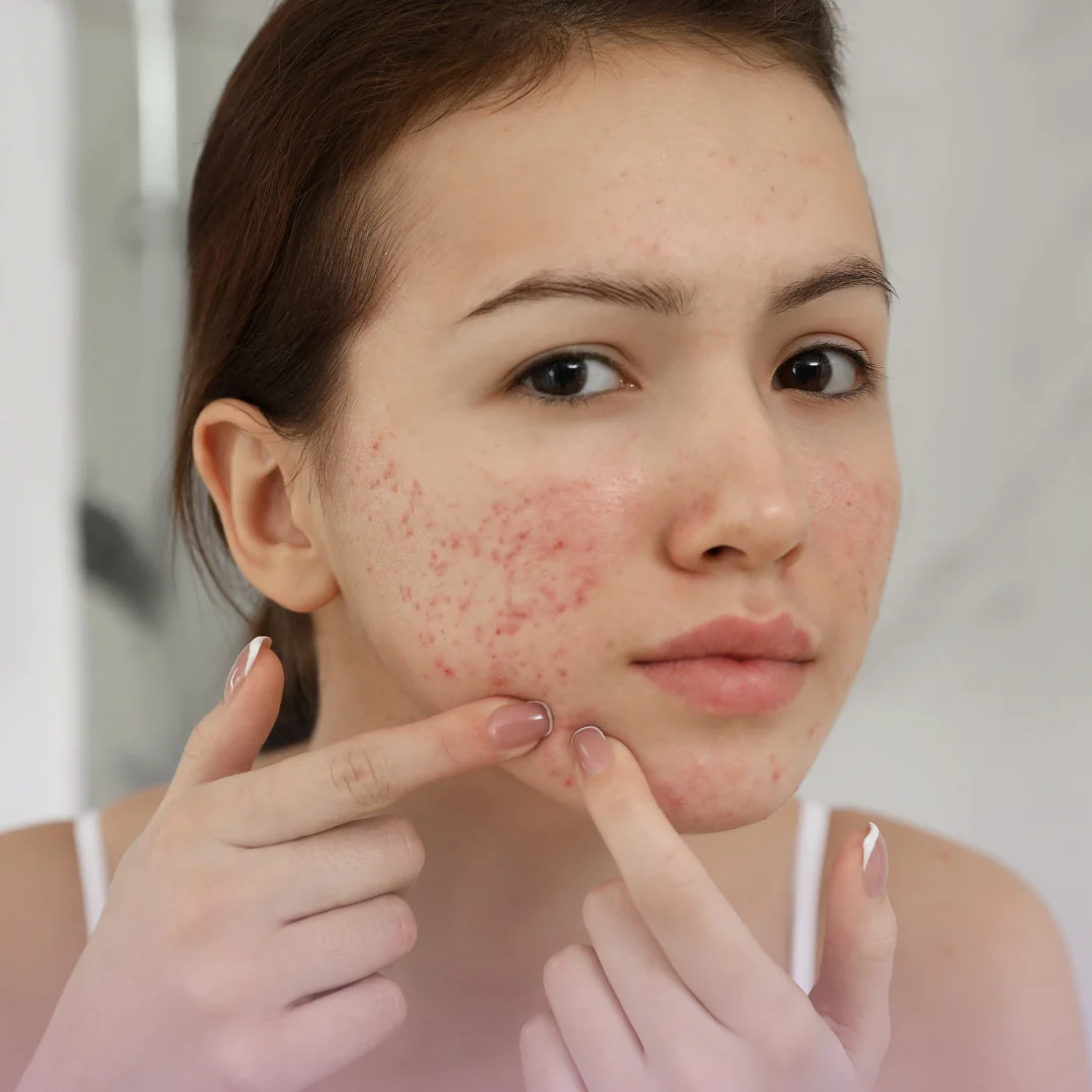 acne-and-acne-scar-masterclass-milton keynes